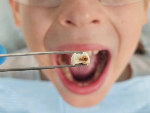 Emergency Dental Filling Replacement in IA